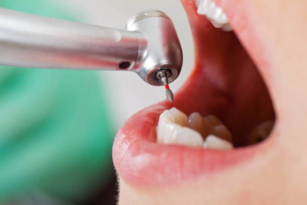 Best Urgent Care for Lost Fillings or Crowns in Laurel, MS